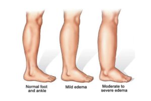 Lymphedema image and how leg stocking can help treat it