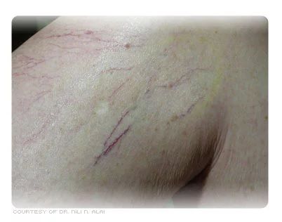 Mild spider veins