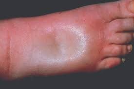 Oedema