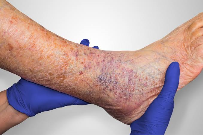 An example of a lower extremity wound - venous disease