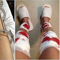include support hoses in post corrective surgery