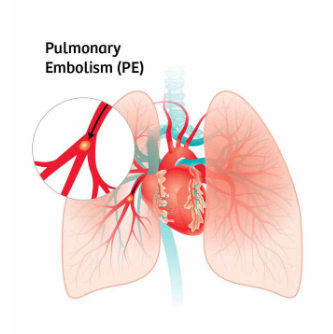 pulmonary embolism