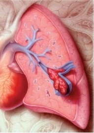 A 3-D image of a clot in a lung indicating the importance of anti-clot stockings