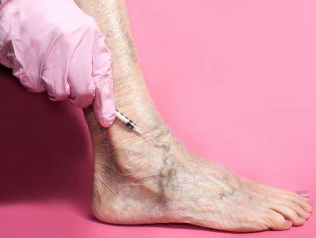 Sclerotherapy