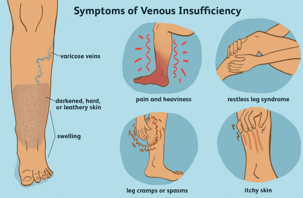 Graphic explaining symptoms of Venous Reflux Disease