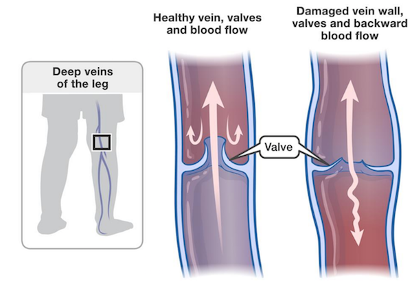 Circulation Socks - Improve Leg Circulation Now (with Photos!)