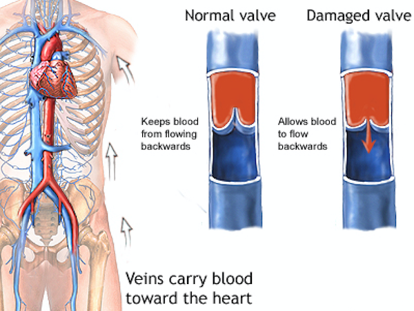 Diagram of normal valve vs damaged valve carrying blood towards the heart