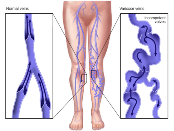 Graphical representation of normal and varicose veins