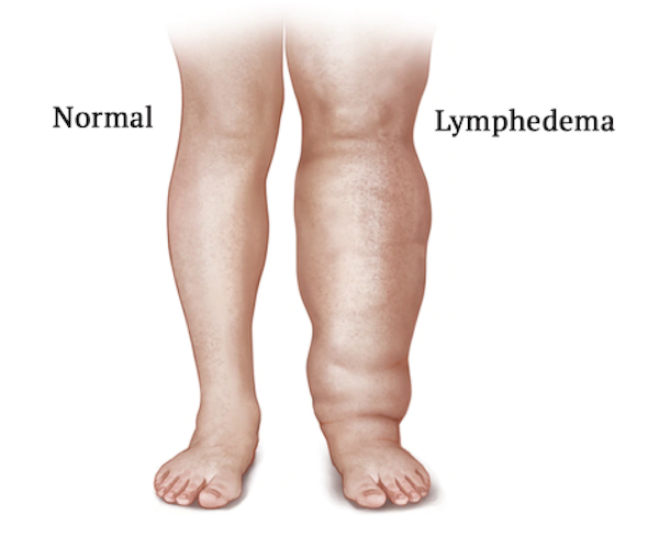 Graphic of Lymphedema