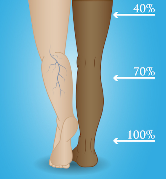 Compression level of graduated compression pantyhose graphic