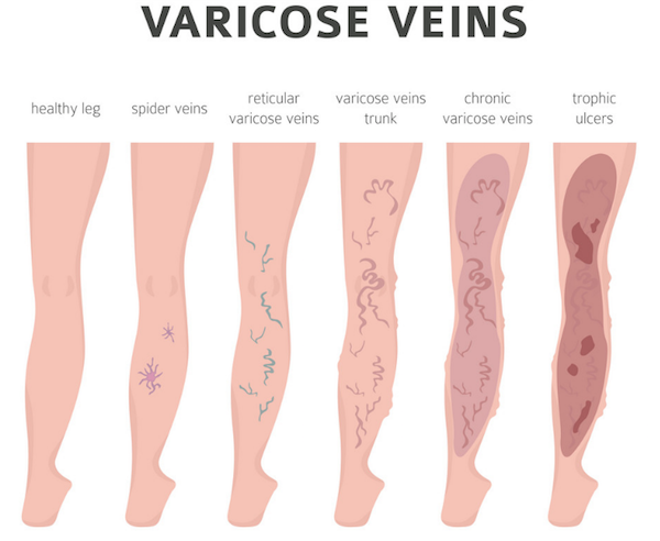 How long should you wear compression socks for varicose veins Compression Stockings Varicose Veins Prevent Ugly Veins