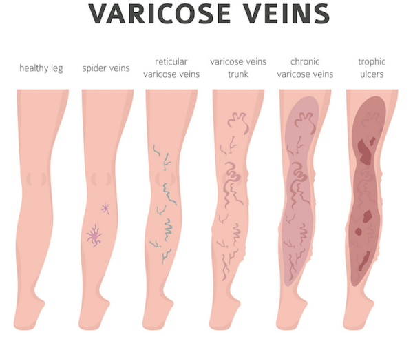 Do compression stockings help to treat varicose veins? - SUCH TV