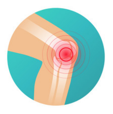 Graphic of knee injury