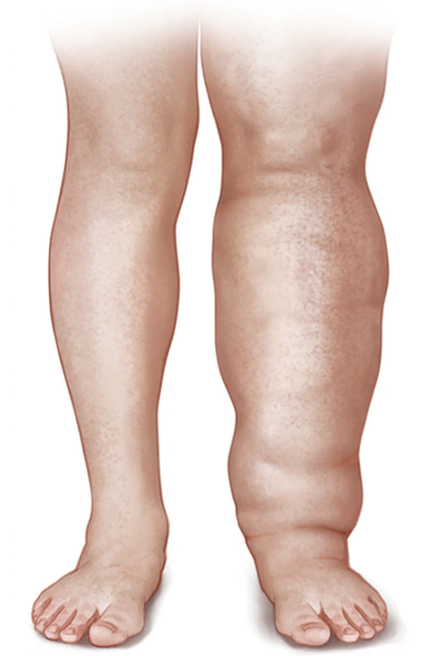 Wearing compression socks can prevent and treat lymphedema