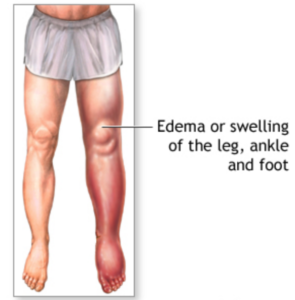 Compression Socks For Edema - (The Ultimate Guide!)