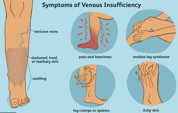 Compression stockings help combat venous insufficiency