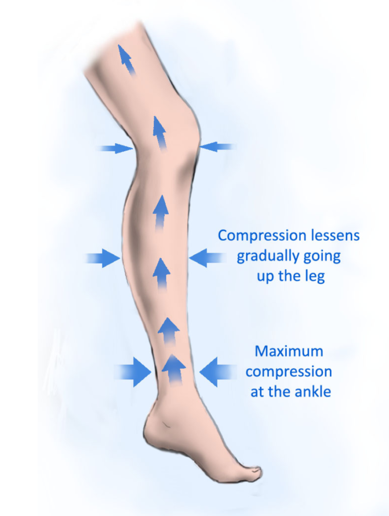 Compression Socks Give Maximum Compression at the Ankle and Gradually Lessens as the Stockings Go Up the Leg. 