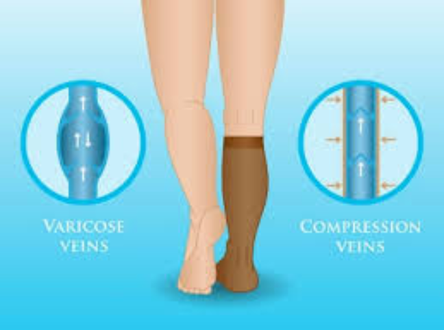 How Compression Veins Help Varicose Veins