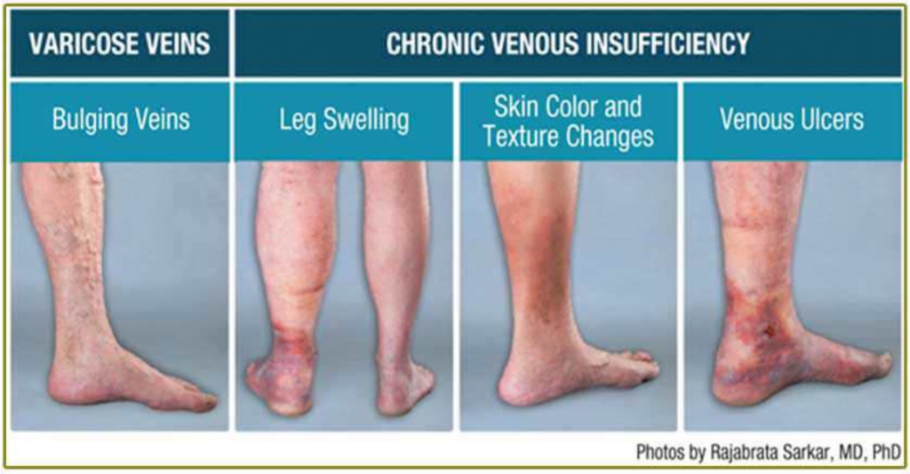 Varicose Veins vs Chronic Venous Insufficiency 