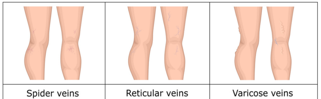 Medical use of compression socks