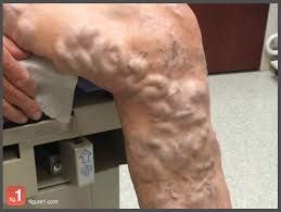 Severe varicose veins 