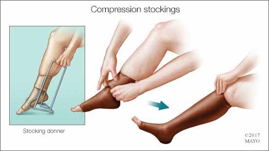 Stocking Donner Used In Wearing Compression Stockings