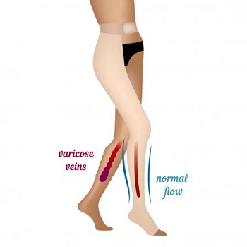 Varicose veins vs Normal flow