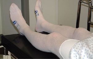  A surgical patient in anti-thrombosis stockings