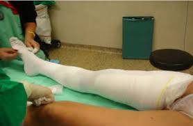 Surgical recovery compression socks