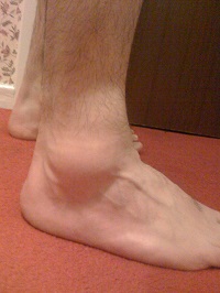 Swelling in the ankle