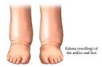 Compression Socks for Swelling (Edema) - Stop Swelling Now!