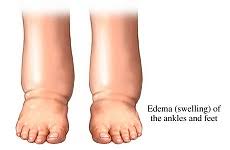 An image of swollen edema feet