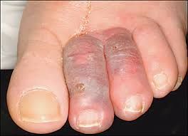 Swollen toes