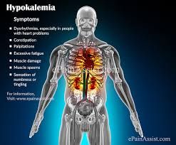 Symptoms Of Hypokalemia