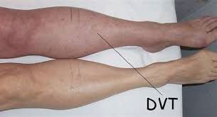 Symptoms of DVT