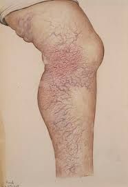 Symptoms of Varicose Veins 