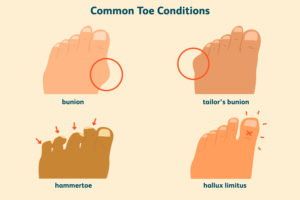 common toe conditions