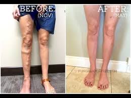 Treating Varicose Veins