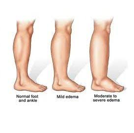 How Long Should I Wear Compression Socks After Ankle Surgery