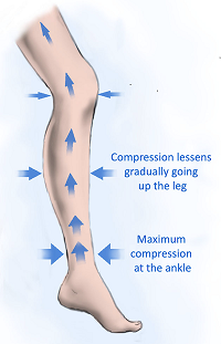 A diagram showing how the graduated pressure works