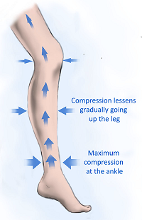 An image showing how pressure socks work