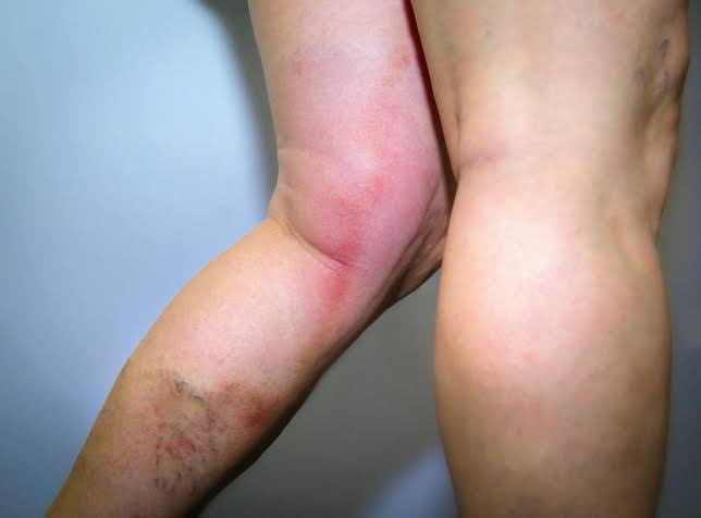 Real image of a leg with varicose veins