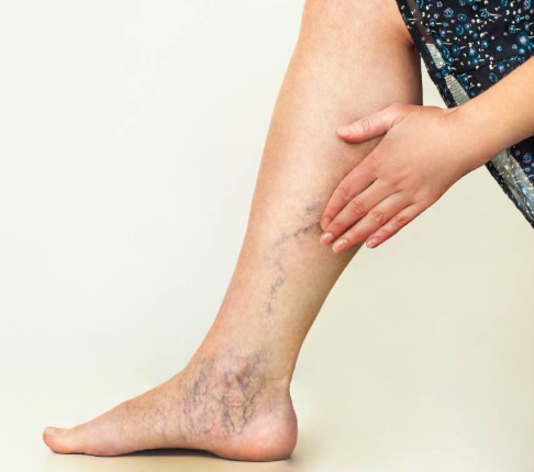 Signs of varicose in your leg include an appearance of bulging veins on the legs and feet. 