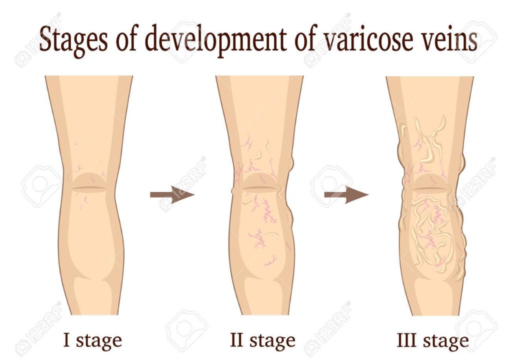 Full Leg Compression Sleeve Complete Guide (with Pictures!)