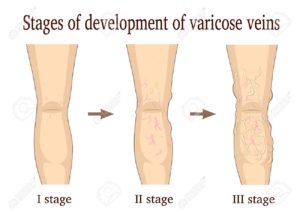 Varicose Veins Development image