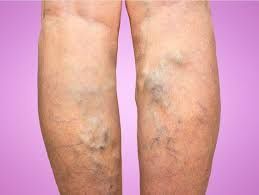 Varicose veins