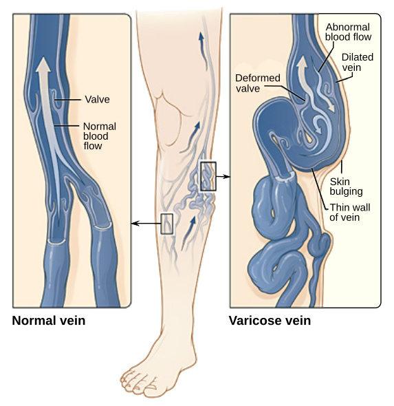 vericose veins in work