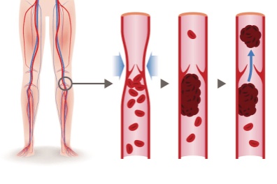 Images explaining how valves work in varicose veins