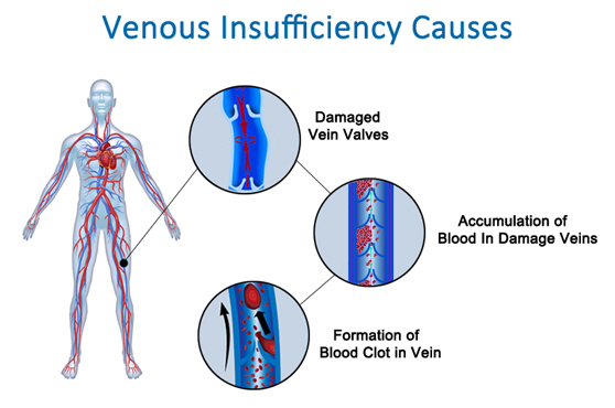 Graphic of venous insufficiency showing blood flow disruption in damaged vein valves