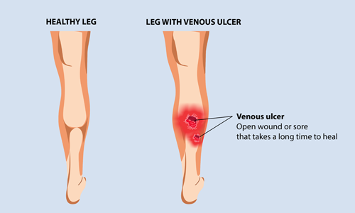 compression techniques can prevent venous ulcers